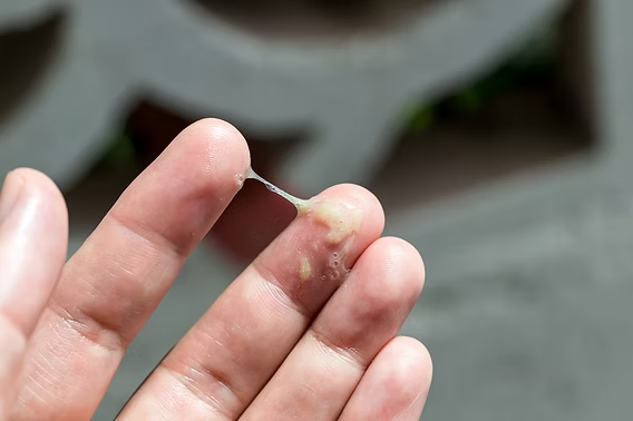 vaginal discharge treatment in Thane